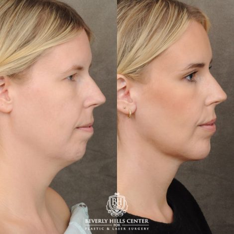 female patient before and after Brow Lift & Weekend Neclkift