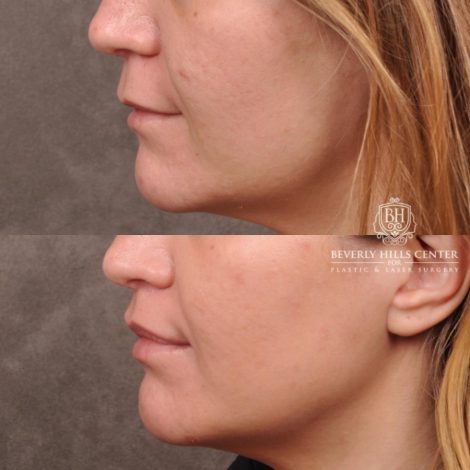 female patient before and after CUPID LIFT® Lip Lift