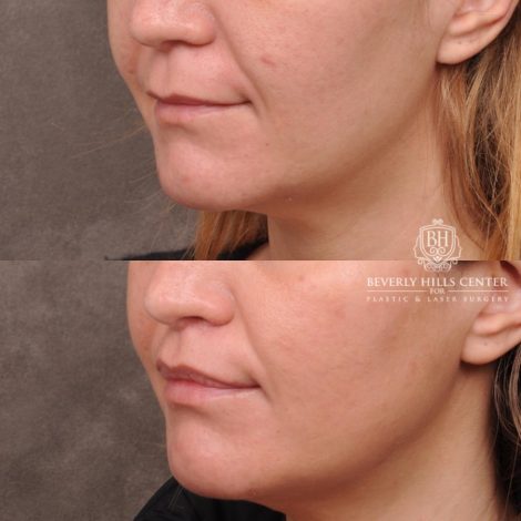 female patient before and after CUPID LIFT® Lip Lift