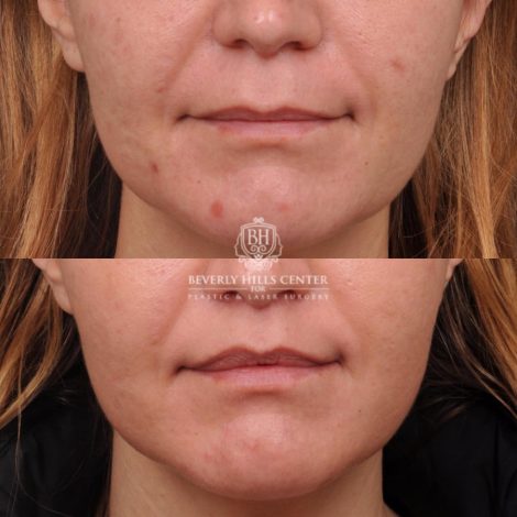 female patient before and after CUPID LIFT® Lip Lift
