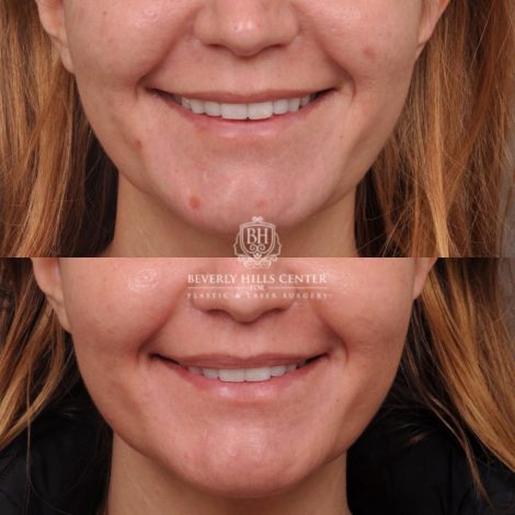 female patient before and after CUPID LIFT® Lip Lift