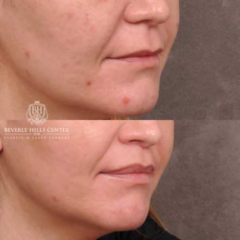 female patient before and after CUPID LIFT® Lip Lift