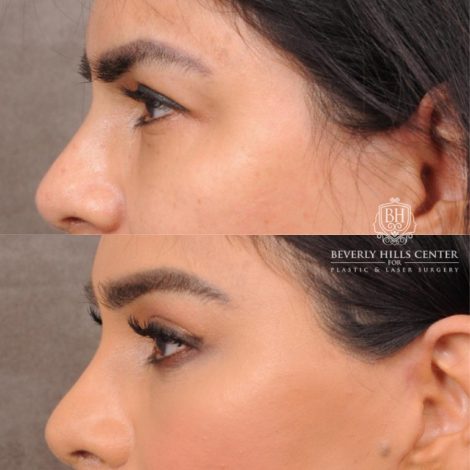 female patient before and after Brow Lift and CUPID LIFT® Lip Lift