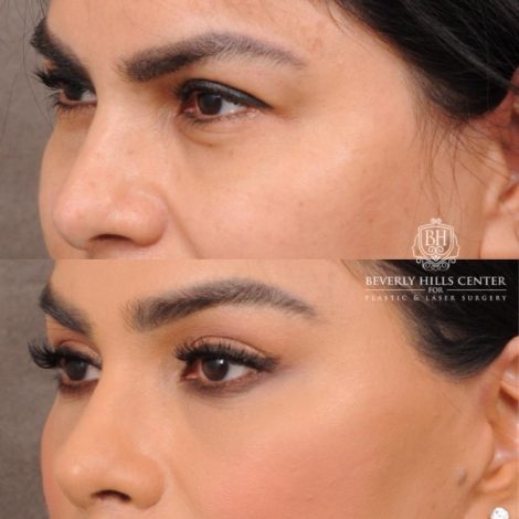 female patient before and after Brow Lift and CUPID LIFT® Lip Lift