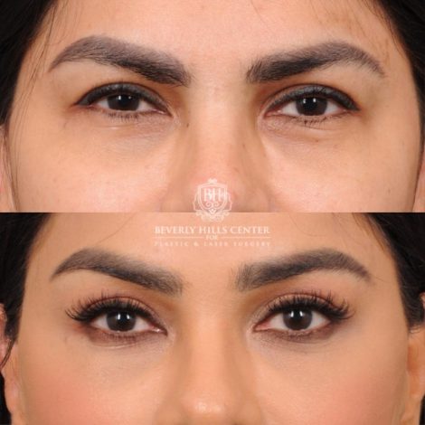 female patient before and after Brow Lift and CUPID LIFT® Lip Lift
