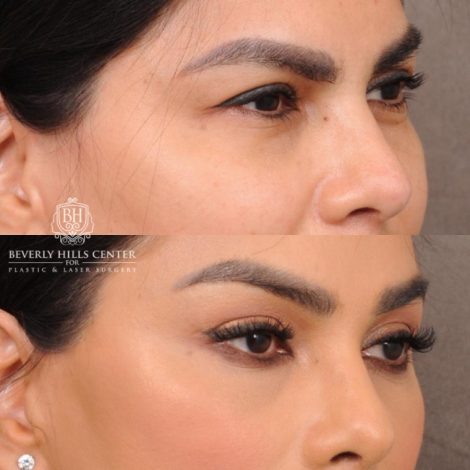 female patient before and after Brow Lift and CUPID LIFT® Lip Lift