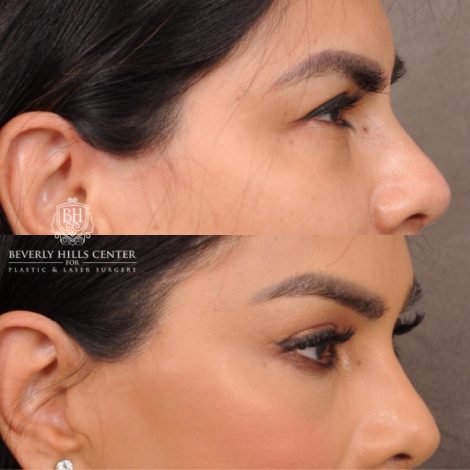female patient before and after Brow Lift and CUPID LIFT® Lip Lift