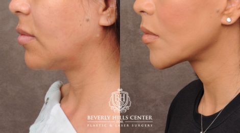 female patient before and after Brow Lift and CUPID LIFT® Lip Lift