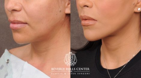 female patient before and after Brow Lift and CUPID LIFT® Lip Lift