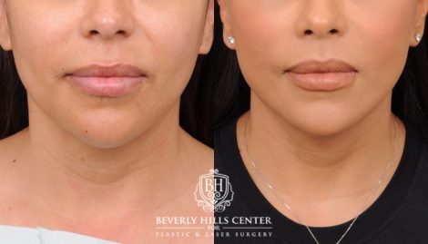 female patient before and after Brow Lift and CUPID LIFT® Lip Lift