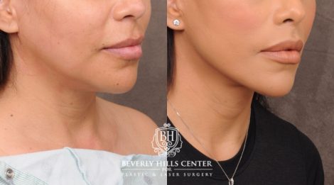 female patient before and after Brow Lift and CUPID LIFT® Lip Lift