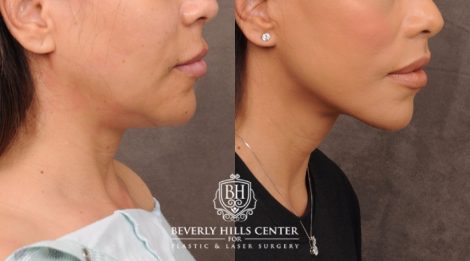female patient before and after Brow Lift and CUPID LIFT® Lip Lift