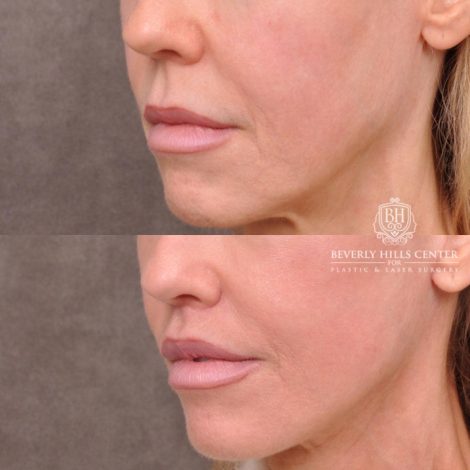 female patient before and after deep plane lip lift with co2 laser resurfacing