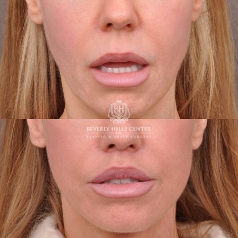 female patient before and after deep plane lip lift with co2 laser resurfacing