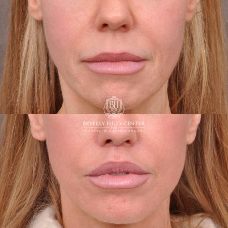 female patient before and after deep plane lip lift with co2 laser resurfacing