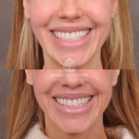 female patient before and after deep plane lip lift with co2 laser resurfacing