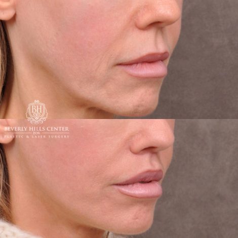 female patient before and after deep plane lip lift with co2 laser resurfacing