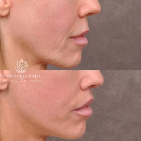 female patient before and after deep plane lip lift with co2 laser resurfacing