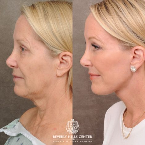 female patient before and after AuraLyft, Brow Lift, Upper & Lower Blepharoplasty, CUPID LIFT® Corner Lift