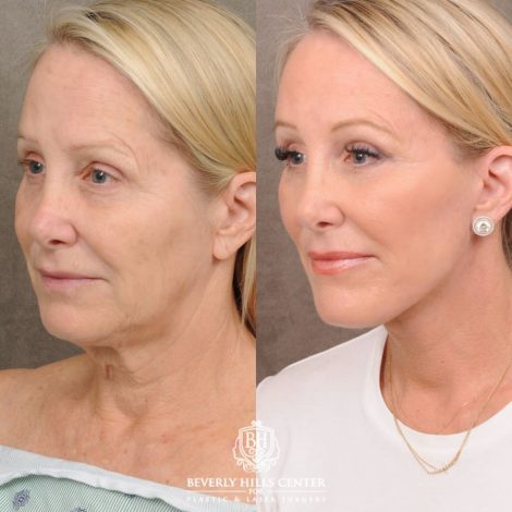 female patient before and after AuraLyft, Brow Lift, Upper & Lower Blepharoplasty, CUPID LIFT® Corner Lift