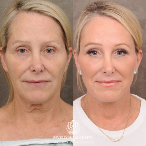 female patient before and after AuraLyft, Brow Lift, Upper & Lower Blepharoplasty, CUPID LIFT® Corner Lift