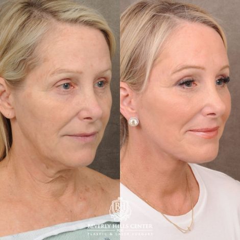 female patient before and after AuraLyft, Brow Lift, Upper & Lower Blepharoplasty, CUPID LIFT® Corner Lift