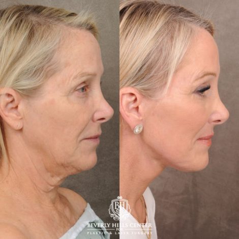 female patient before and after AuraLyft, Brow Lift, Upper & Lower Blepharoplasty, CUPID LIFT® Corner Lift