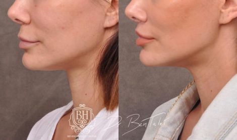 Beverly Hills Center Female Patient Before and After Deep Plane Lip Lift, CUPID LIFT® Corner Lift and Profound RF Skin Tightening
