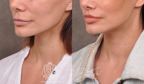 Beverly Hills Center Female Patient Before and After Deep Plane Lip Lift, CUPID LIFT® Corner Lift and Profound RF Skin Tightening