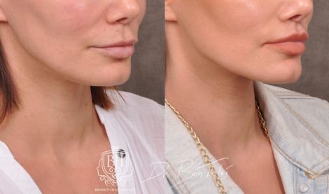 Beverly Hills Center Female Patient Before and After Deep Plane Lip Lift, CUPID LIFT® Corner Lift and Profound RF Skin Tightening
