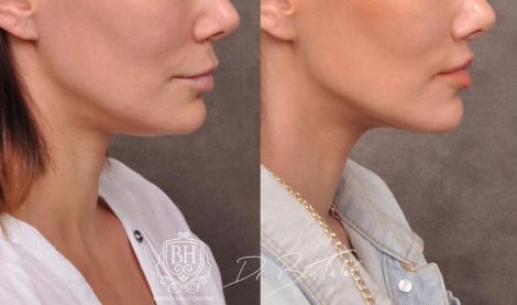 Beverly Hills Center Female Patient Before and After Deep Plane Lip Lift, CUPID LIFT® Corner Lift and Profound RF Skin Tightening