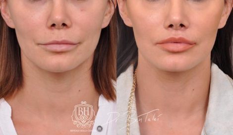 Beverly Hills Center Female Patient Before and After Deep Plane Lip Lift, CUPID LIFT® Corner Lift and Profound RF Skin Tightening