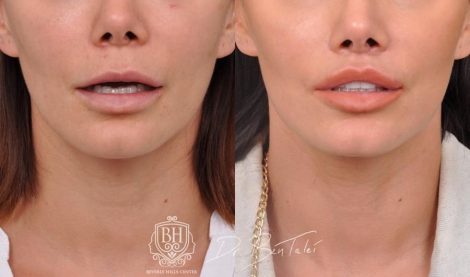 Beverly Hills Center Female Patient Before and After Deep Plane Lip Lift, CUPID LIFT® Corner Lift and Profound RF Skin Tightening