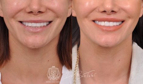 Beverly Hills Center Female Patient Before and After Deep Plane Lip Lift, CUPID LIFT® Corner Lift and Profound RF Skin Tightening