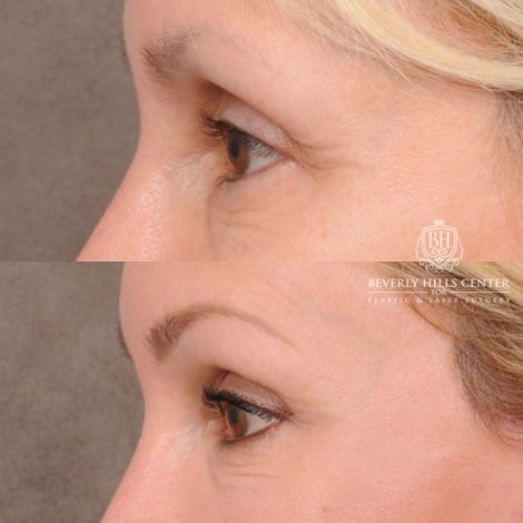 Side-by-side comparison of a womans face before (top) and after (bottom) a cosmetic eyebrow lift procedure, showing smoother skin and higher, more defined eyebrows in the after image.