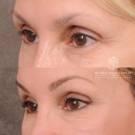 Beverly Hills Center Female Patient Before and After AuraLyft, CUPID LIFT® Corner Lift, Upper Blepharoplasty and Fat Grafting