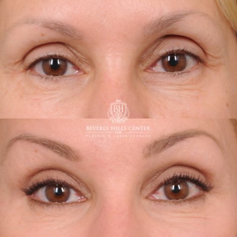 Beverly Hills Center Female Patient Before and After AuraLyft, CUPID LIFT® Corner Lift, Upper Blepharoplasty and Fat Grafting