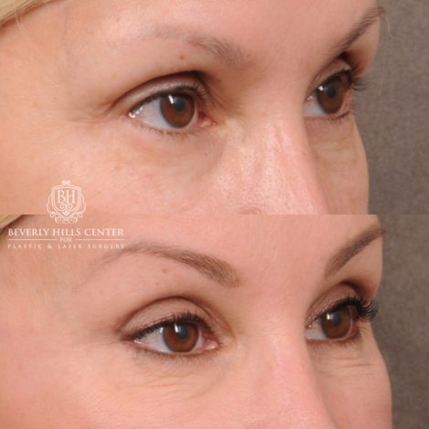 Beverly Hills Center Female Patient Before and After AuraLyft, CUPID LIFT® Corner Lift, Upper Blepharoplasty and Fat Grafting