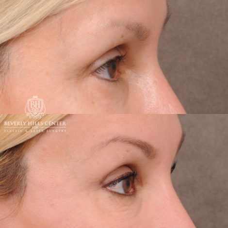 Beverly Hills Center Female Patient Before and After AuraLyft, CUPID LIFT® Corner Lift, Upper Blepharoplasty and Fat Grafting