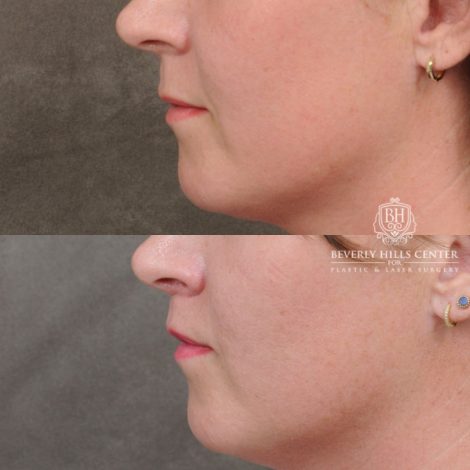 female patient before and after CUPID LIFT® Lip Lift