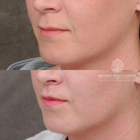 female patient before and after CUPID LIFT® Lip Lift