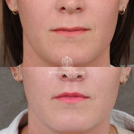 female patient before and after CUPID LIFT® Lip Lift