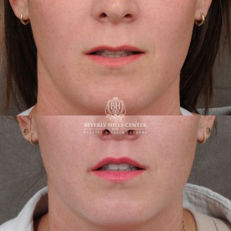 female patient before and after CUPID LIFT® Lip Lift