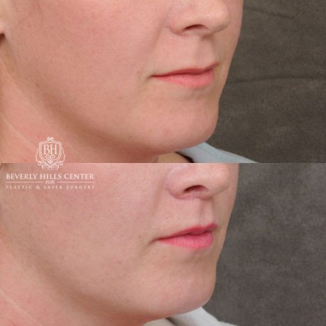 female patient before and after CUPID LIFT® Lip Lift