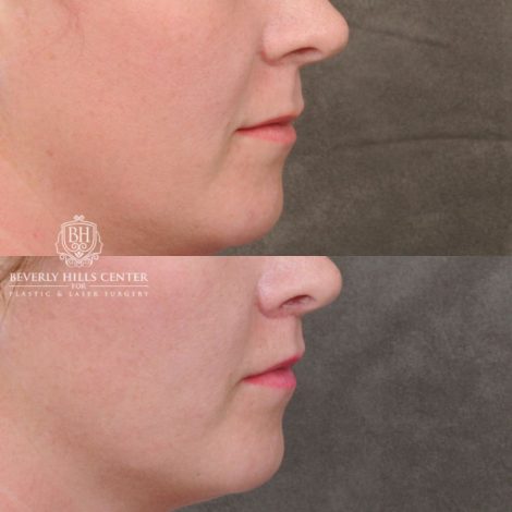 female patient before and after CUPID LIFT® Lip Lift