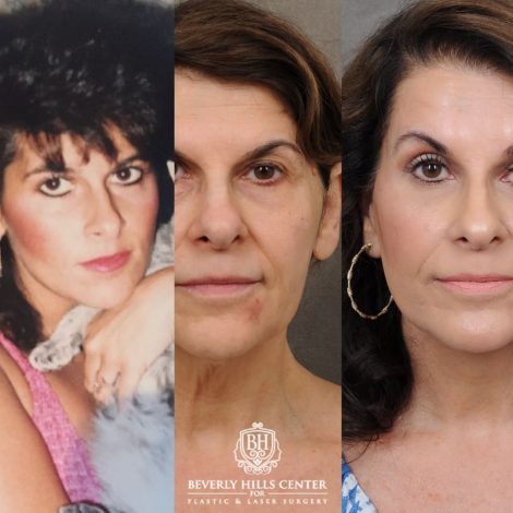 female patient before and after AuraLyft, Brow Lift, CUPID LIFT® Corner Lift, Upper & Lower Blepharoplasty with Fat Grafting