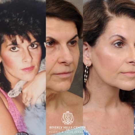 female patient before and after AuraLyft, Brow Lift, CUPID LIFT® Corner Lift, Upper & Lower Blepharoplasty with Fat Grafting