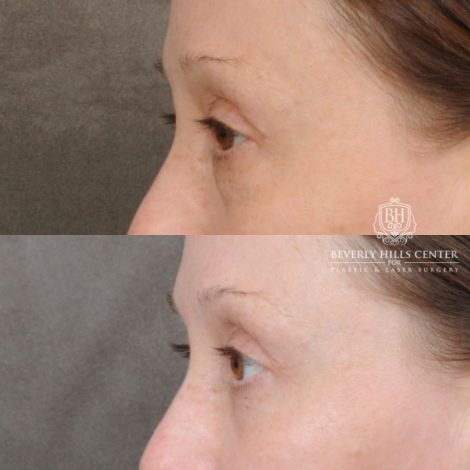 female patient before and after Lower Blepharoplasty
