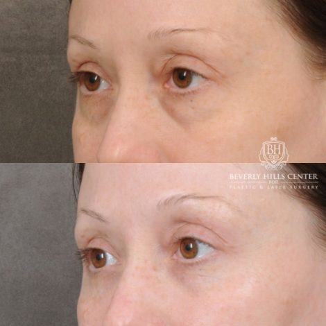 female patient before and after Lower Blepharoplasty