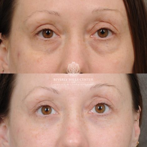 female patient before and after Lower Blepharoplasty